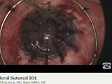 Scleral Sutured IOL