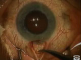 Radial Incision Enclosure