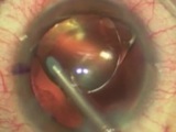 A Simple, One-Handed Method for Rotating a Toric IOL