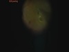 Surgery for Macular Hole and Retinal Detachment
