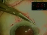 Cataract Surgery in the Fast Lane