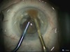 Managing the Posterior Capsular Tear