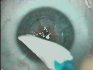Surface ablation with mytomycin C and placement of Nexis Ocular Shield