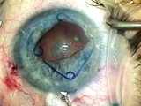 Malyugin Ring for Small Pupil, Shallow AC
