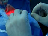 Self-Retaining Bicanaliculus Intubation