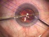 Toric IOL Alignment With the Callisto Z Align