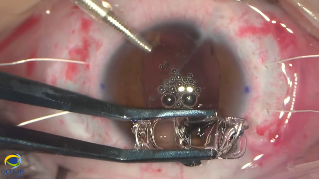 Secondary IOL and Pupilloplasty in Posttraumatic Phakic Eye