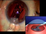 Implanting the Synchrony Dual Optic Accommodating IOL