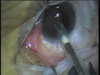 Multi-Piece IOL Insertion Through an Astigmatically Neutral Incision