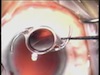 Implanting the enVista IOL